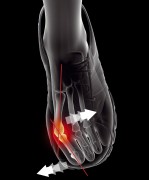 Orthèse Hallux Valgus